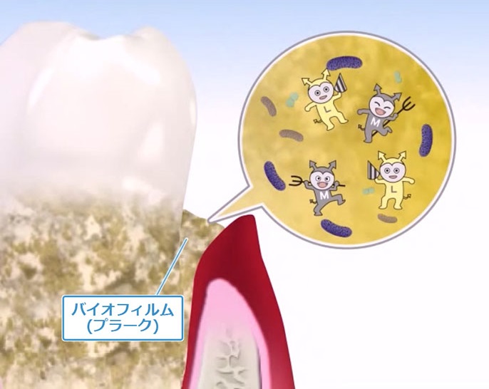 歯周病の発生要因