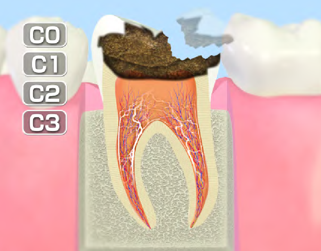 歯髄まで進行したむし歯 (C3)