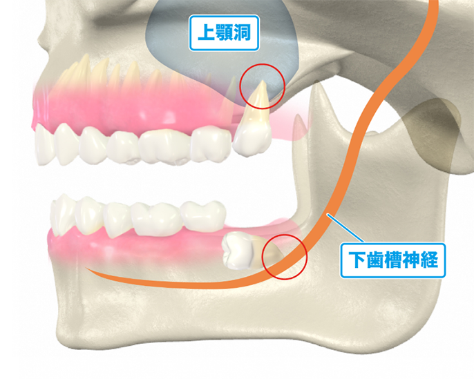 親知らずの抜歯