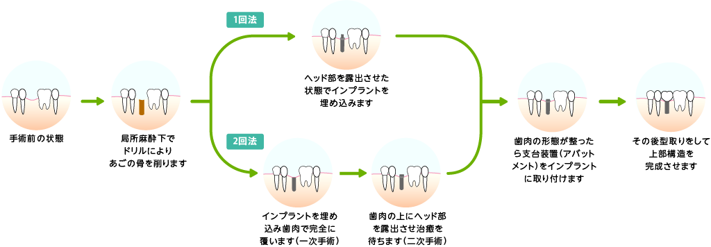 2回法による治療