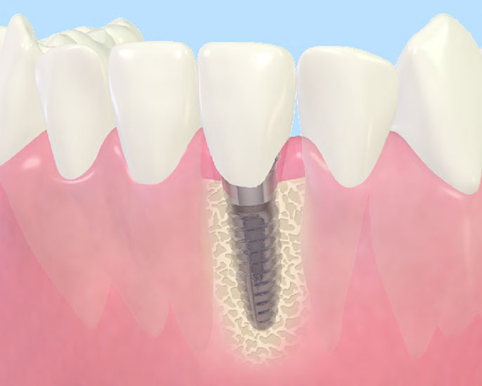 インプラントとは